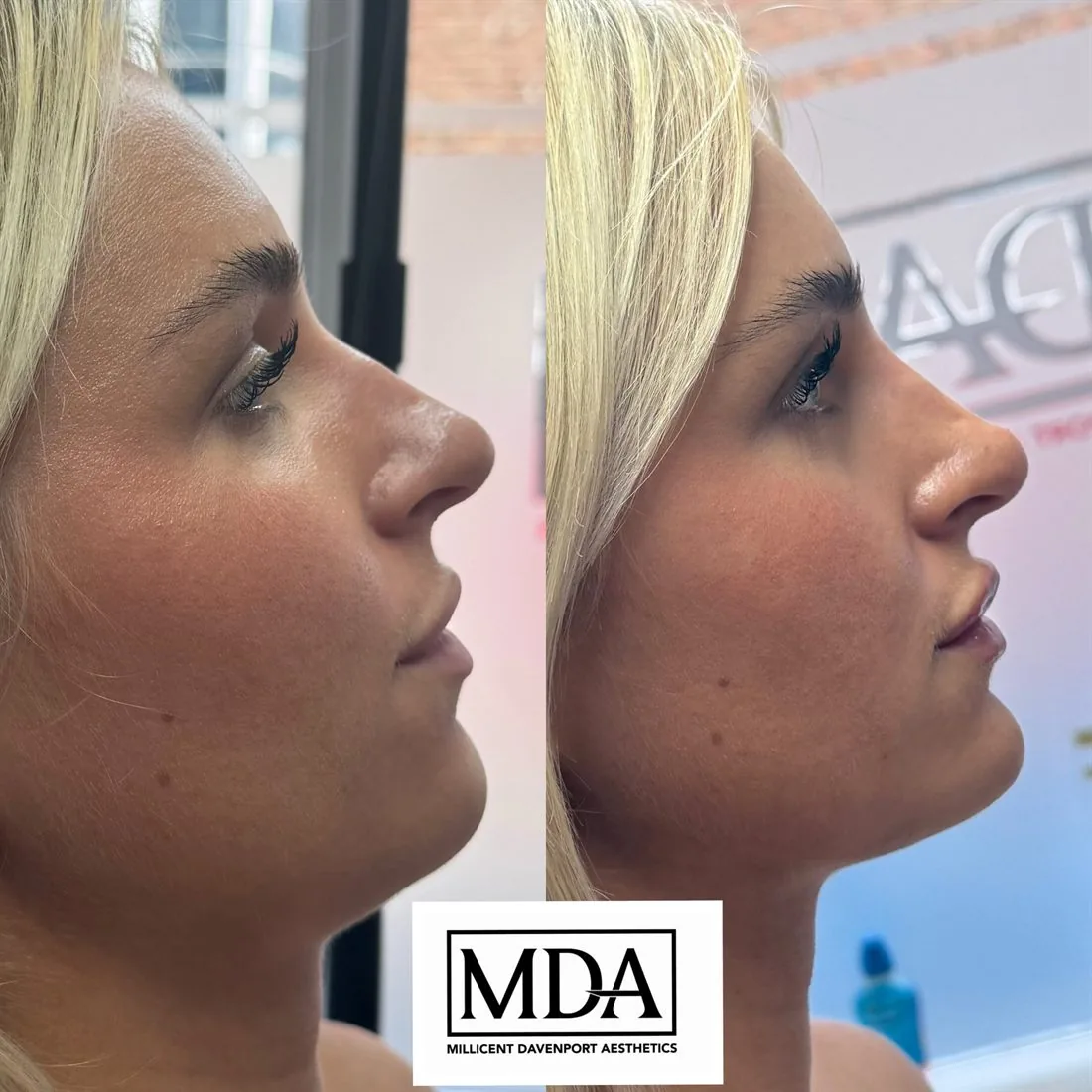 Treatment result 1